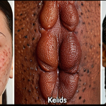 **

A close-up shot of various types of skin scars (keloids, hypertrophic, acne) on different skin tones, emphasizing their textures and appearances. Focus on the "before" state.
**